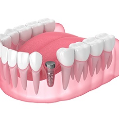 Illustration of dental implant in Rockville, MD in jaw