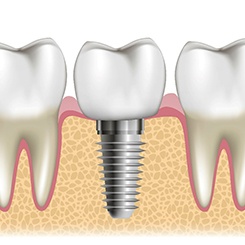 Illustration of dental implant in Rockville, MD with crown