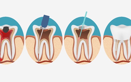 an illustration of the root canal process in Rockville