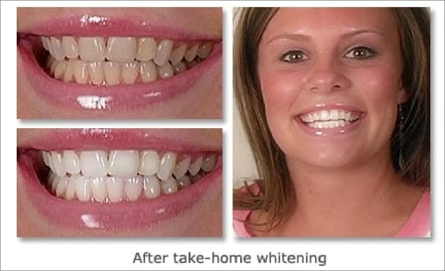 Patient's smile before and after take home teeth whitening