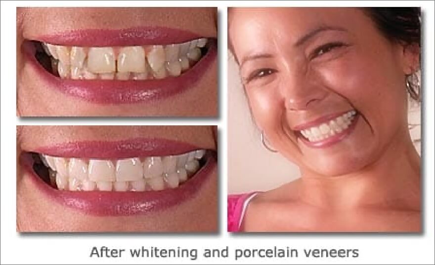 Patient's smile before and after teeth whitening and porcelain veneers