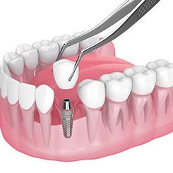 Illustration of single dental implant