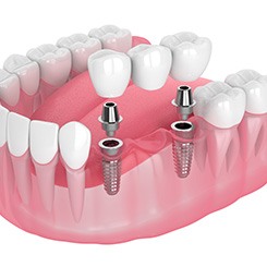 Illustration of implant bridge