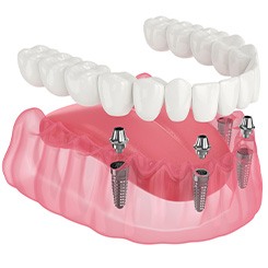 Illustration of implant denture