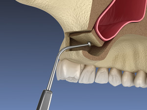 Illustration of sinus lift surgery being performed